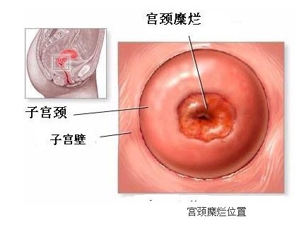 宫颈糜烂最新手术治疗技术进展及未来展望